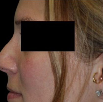 Rhinoplasty Before & After Patient #81