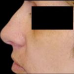 Rhinoplasty Before & After Patient #84