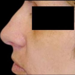Rhinoplasty Before & After Patient #84
