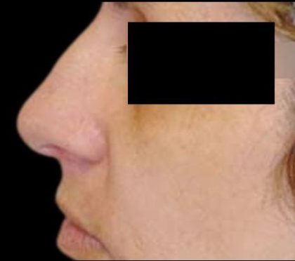 Rhinoplasty Before & After Patient #84