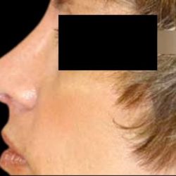 Rhinoplasty Before & After Patient #84