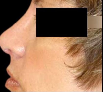 Rhinoplasty Before & After Patient #84