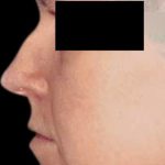 Rhinoplasty Before & After Patient #87