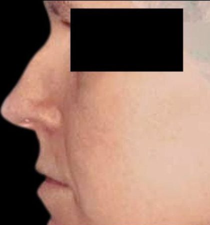 Rhinoplasty Before & After Patient #87