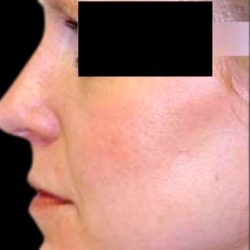Rhinoplasty Before & After Patient #87