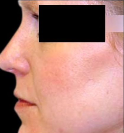 Rhinoplasty Before & After Patient #87