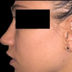 Rhinoplasty Before & After Patient #92