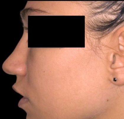 Rhinoplasty Before & After Patient #92