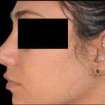 Rhinoplasty Before & After Patient #92