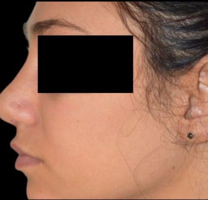 Rhinoplasty Before & After Patient #92