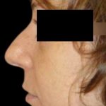 Rhinoplasty Before & After Patient #78