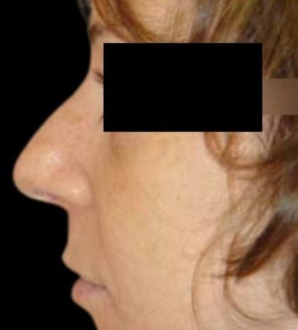 Rhinoplasty Before & After Patient #78