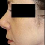 Rhinoplasty Before & After Patient #78