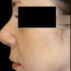 Rhinoplasty Before & After Patient #78