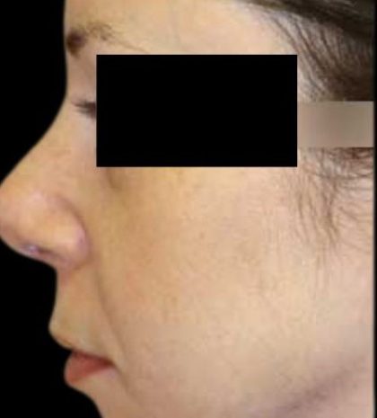 Rhinoplasty Before & After Patient #78