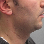 Ultherapy Before & After Patient #303