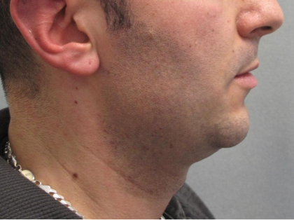 Ultherapy Before & After Patient #303