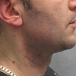 Ultherapy Before & After Patient #303