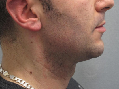 Ultherapy Before & After Patient #303