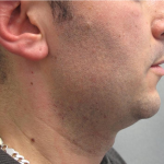 Ultherapy Before & After Patient #303