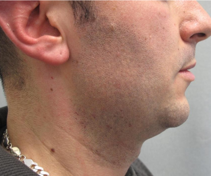 Ultherapy Before & After Patient #303