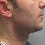 Ultherapy Before & After Patient #303
