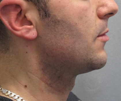 Ultherapy Before & After Patient #303