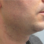 Ultherapy Before & After Patient #303