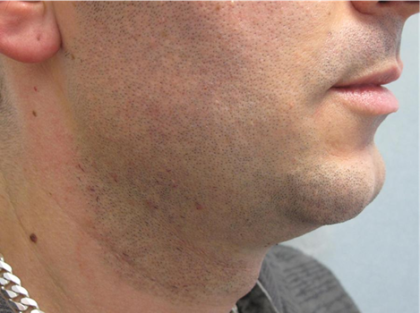 Ultherapy Before & After Patient #303