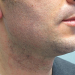 Ultherapy Before & After Patient #303