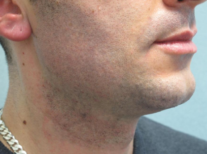 Ultherapy Before & After Patient #303
