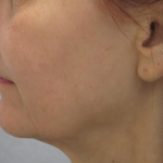 Ultherapy Before & After Patient #306