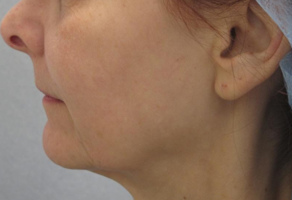 Ultherapy Before & After Patient #306