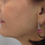 Ultherapy Before & After Patient #306