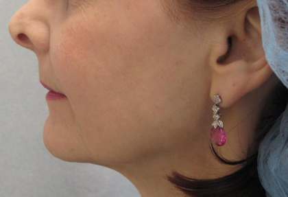 Ultherapy Before & After Patient #306