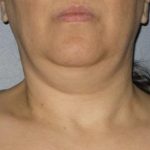 Ultherapy Before & After Patient #2705