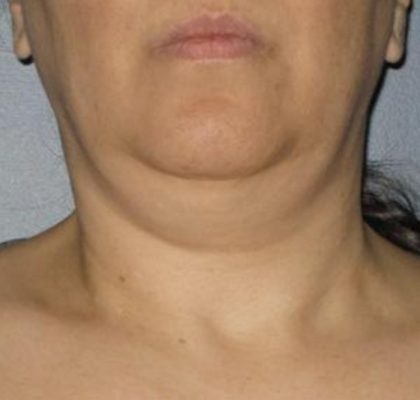 Ultherapy Before & After Patient #2705