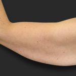 Brachioplasty (Arm Lift) Before & After Patient #2516