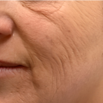 Botox Before & After Patient #2578