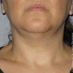 Ultherapy Before & After Patient #2705