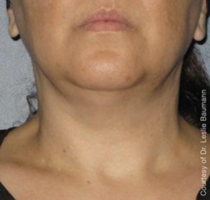 Ultherapy Before & After Patient #2705