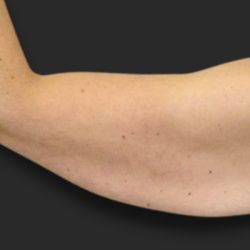 Brachioplasty (Arm Lift) Before & After Patient #2516