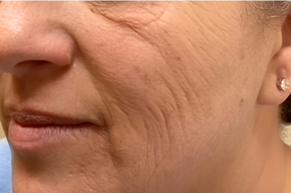 Botox Before & After Patient #2578