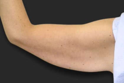 Brachioplasty (Arm Lift) Before & After Patient #2516