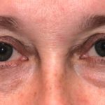 Blepharoplasty Before & After Patient #2525