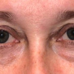 Blepharoplasty Before & After Patient #2525