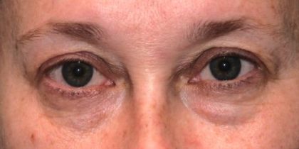 Blepharoplasty Before & After Patient #2525