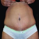 Tummy Tuck Before & After Patient #2504