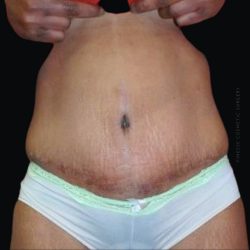 Tummy Tuck Before & After Patient #2504