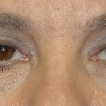 Blepharoplasty Before & After Patient #2529